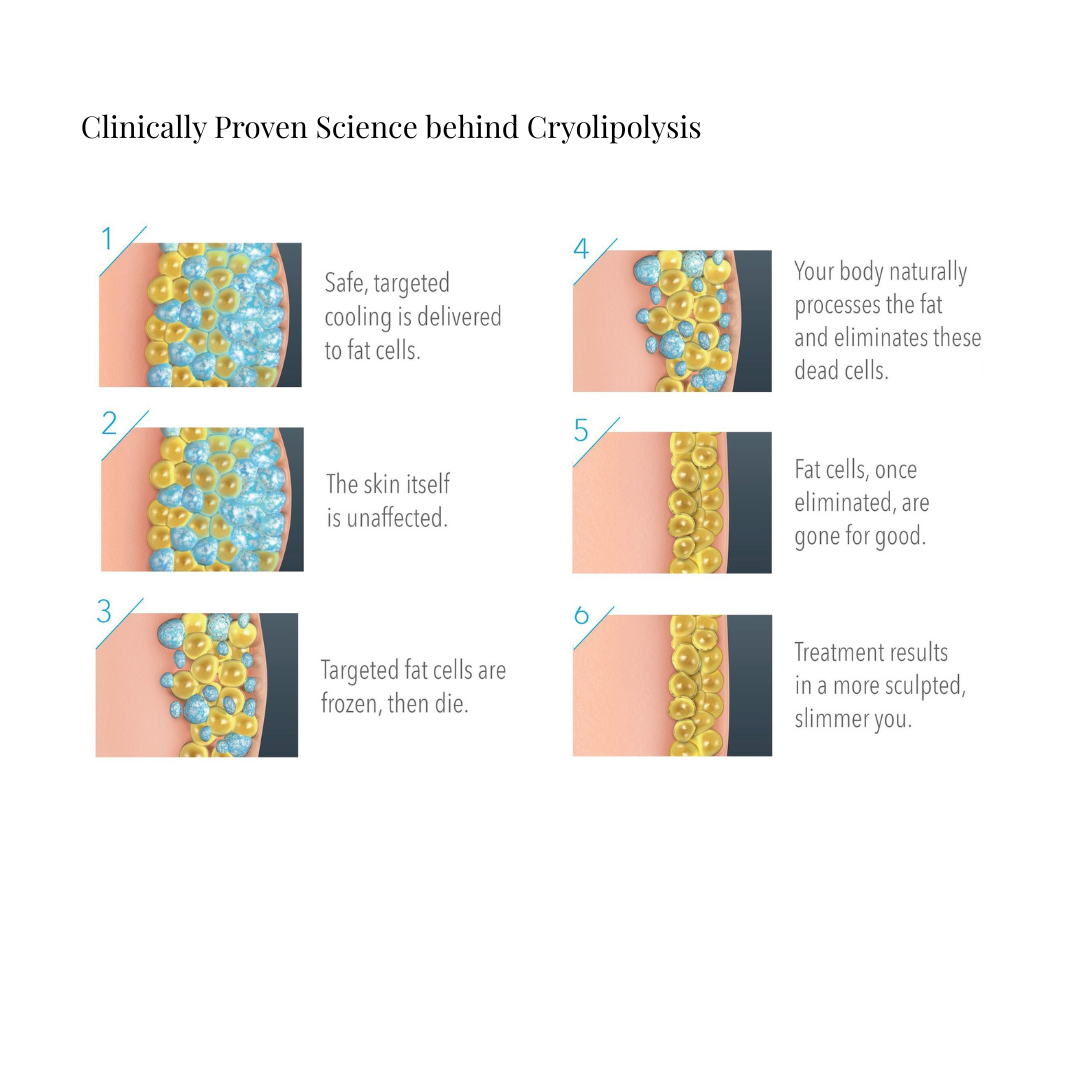 Cryolipolysis - Fat Freezing