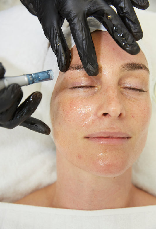 MicroNeedling