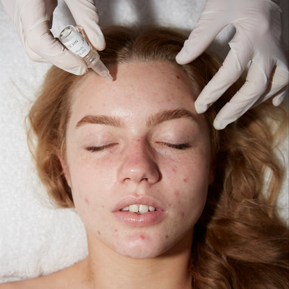 SQT Bio Microneedling