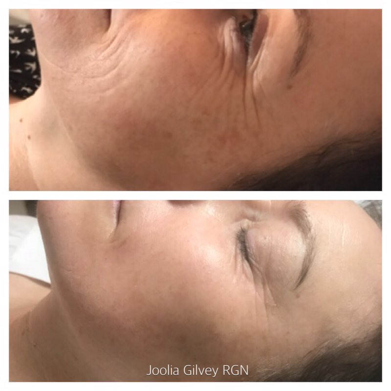 Meso Fusion Needling