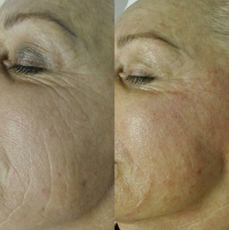 Meso Fusion Needling