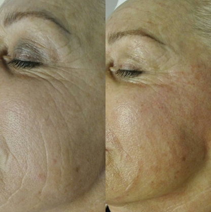 Meso Fusion Needling