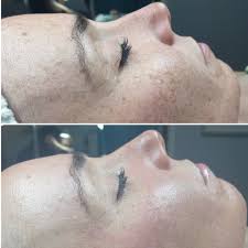 Meso Fusion Needling