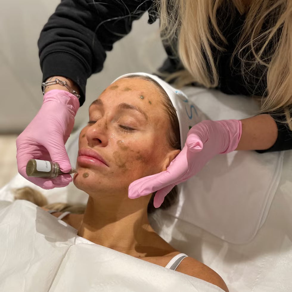 SQT Bio Microneedling