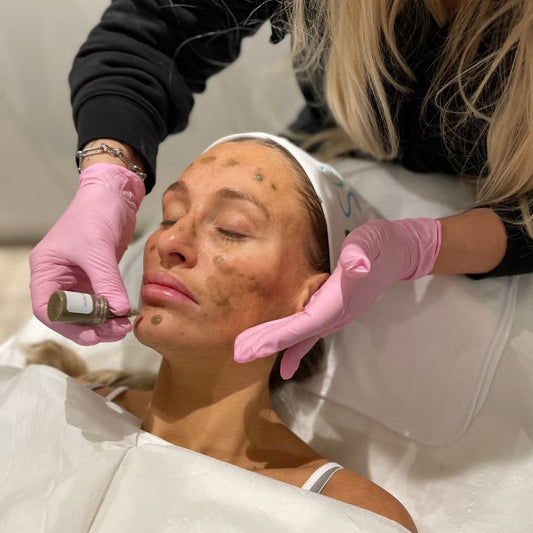 SQT Bio Microneedling