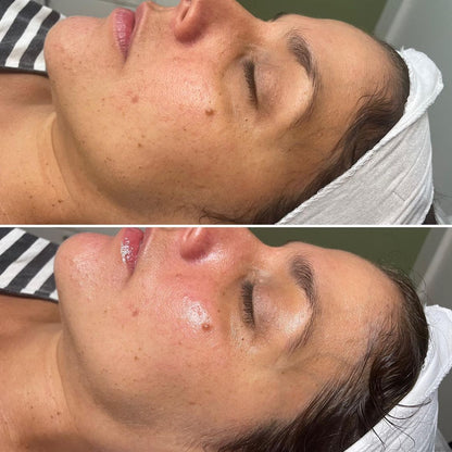 Image Lightening Lift® Peel