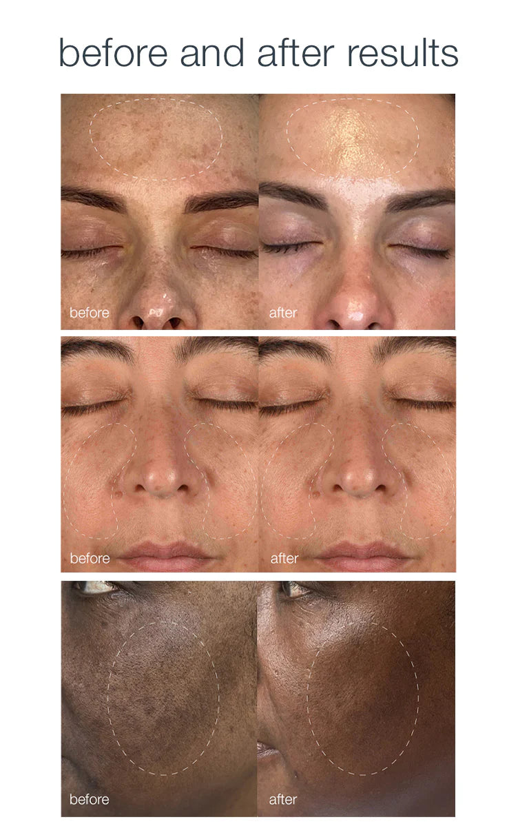 Melanopro Peel Treatment