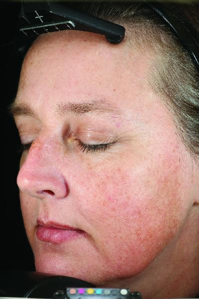 Image Lightening Lift® Peel