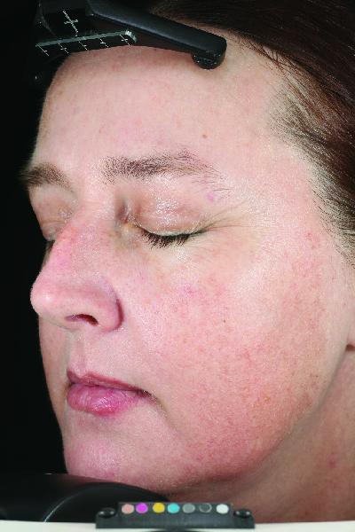 Image Lightening Lift® Peel